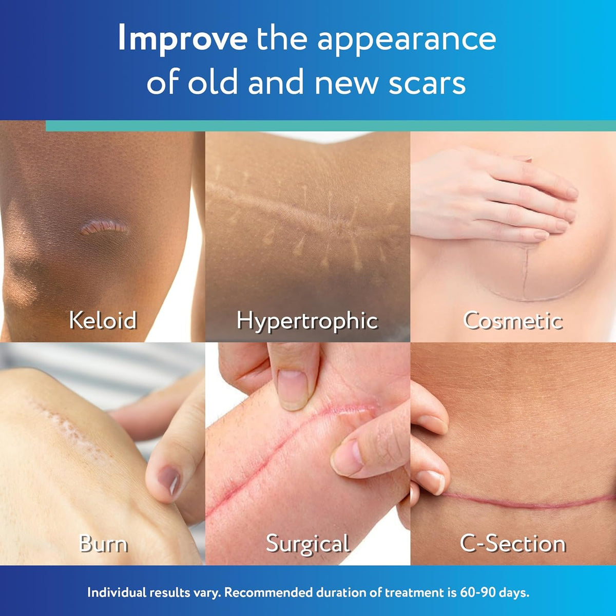 Scaraway Silicone Scar Sheets 10 Fitas Tratamento Cicatrizes